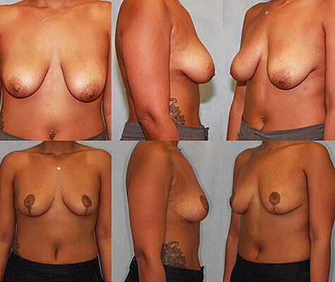 Breast Lift Before & After