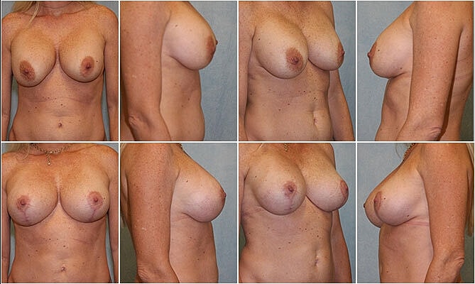 Breast Lift Before & After