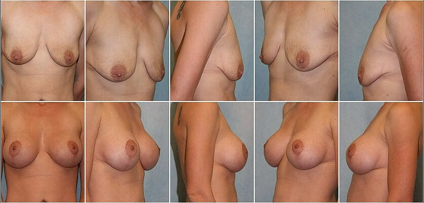 Breast Lift Before & After