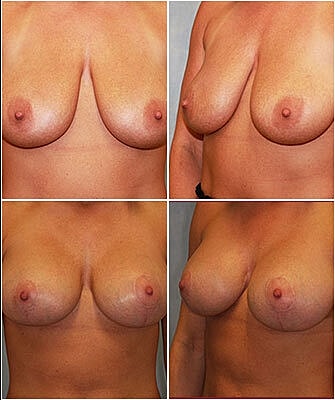 Breast Lift Before & After