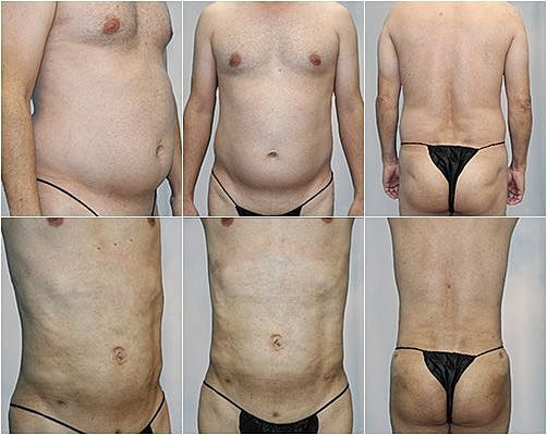 Bbl Before & After