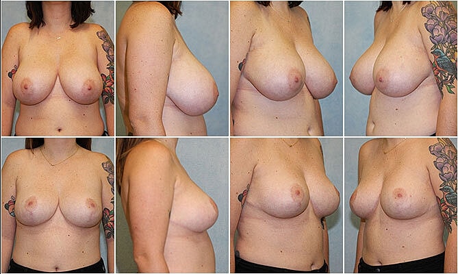Breast Reduction Before & After