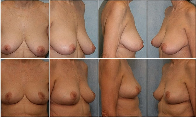 Breast Reduction Before & After