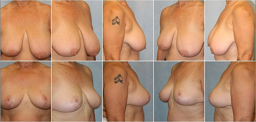 Breast Reduction Before & After
