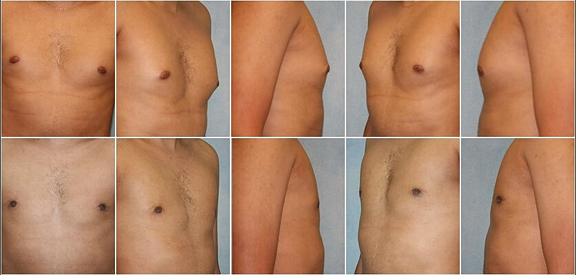 Gynecomastia Surgery Before & After