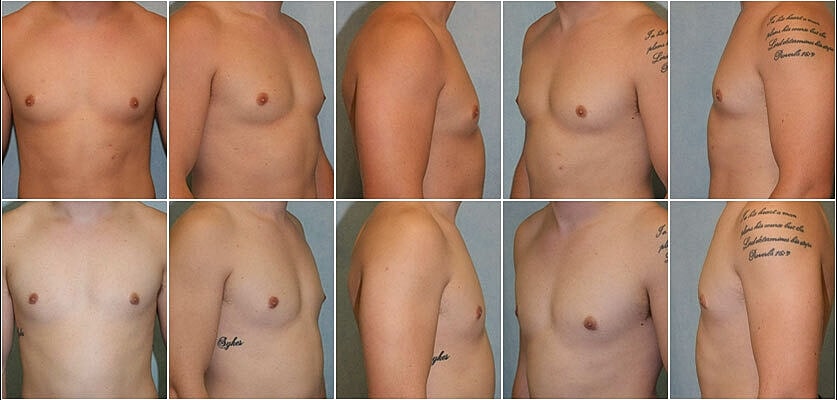 Gynecomastia Surgery Before & After