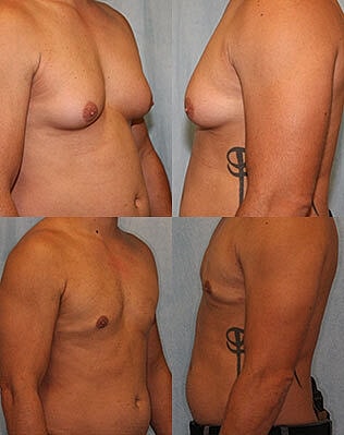 Gynecomastia Surgery Before & After