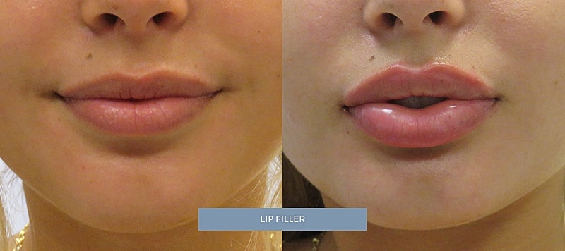 Dermal Filler Before & After