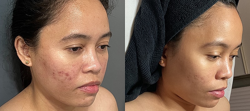 Skin Treatments Before & After