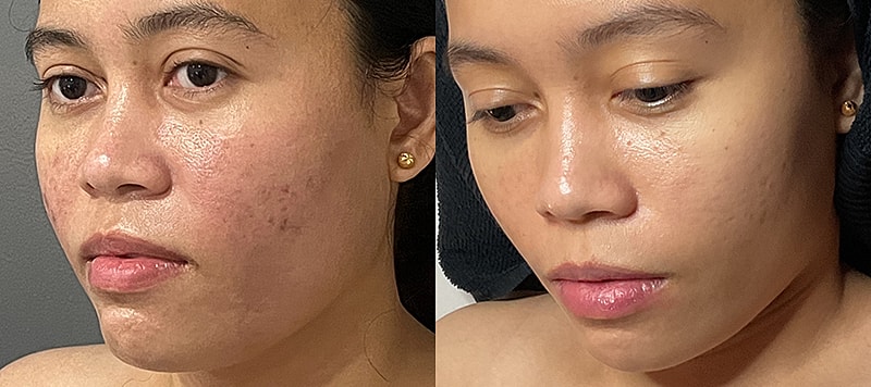 Skin Treatments Before & After