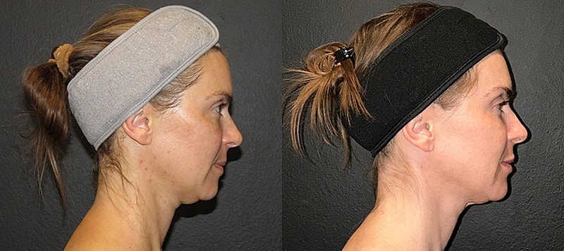 Skin Treatments Before & After