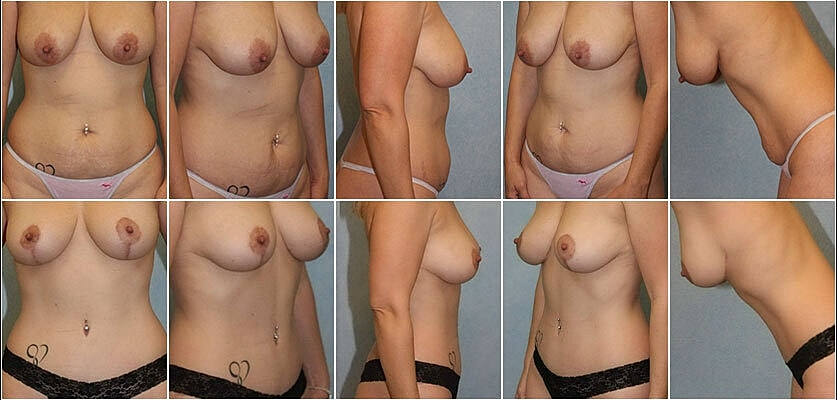 Mommy Makeover Before & After