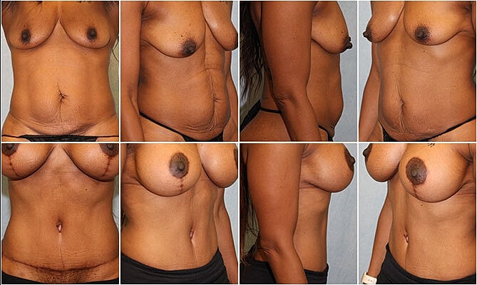 Tummy Tuck Before & After