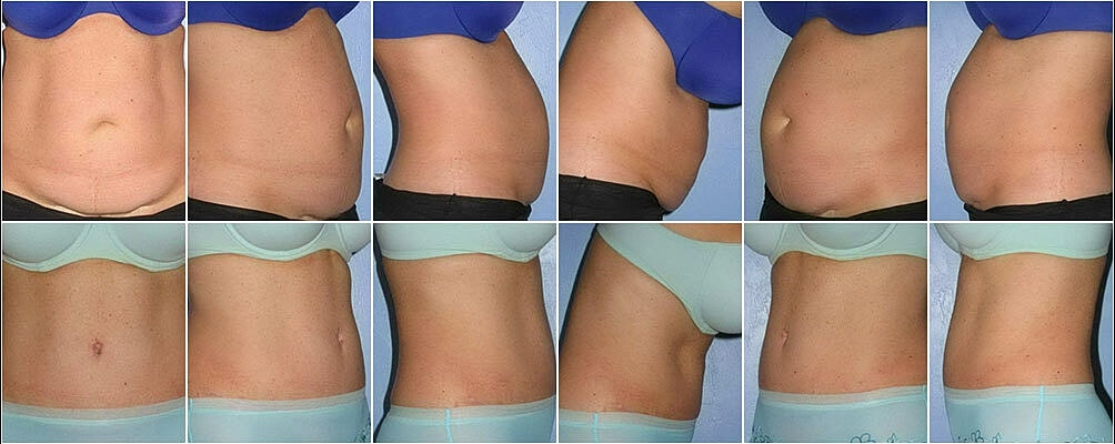 Tummy Tuck Before & After