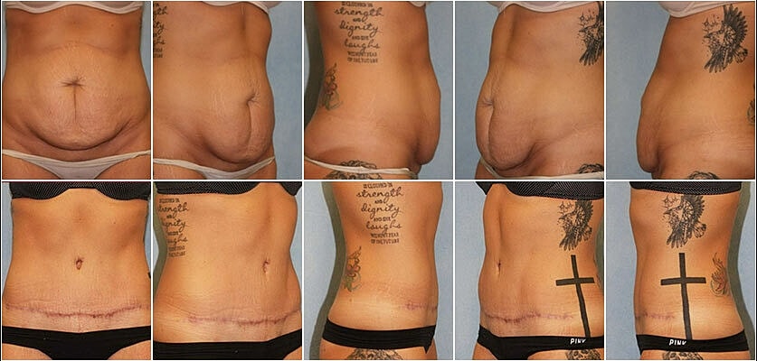 Tummy Tuck Before & After