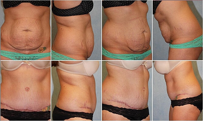 Tummy Tuck Before & After