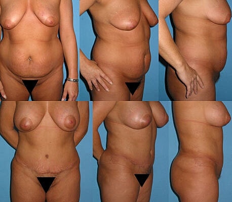 Tummy Tuck Before & After