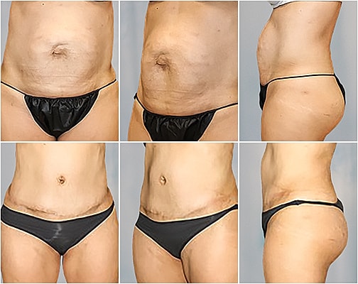 Tummy Tuck Before & After