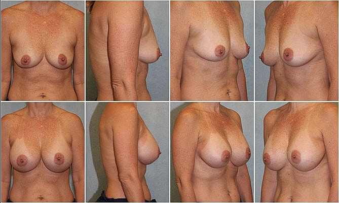 Breast Augmentation Before & After