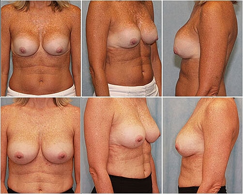 Breast Augmentation Before & After