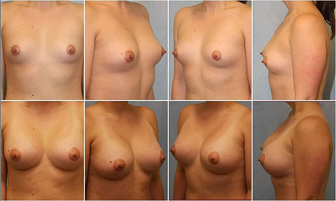 Breast Augmentation Before & After