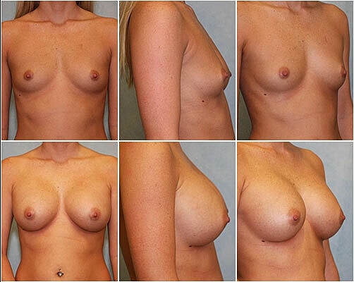 Breast Augmentation Before & After