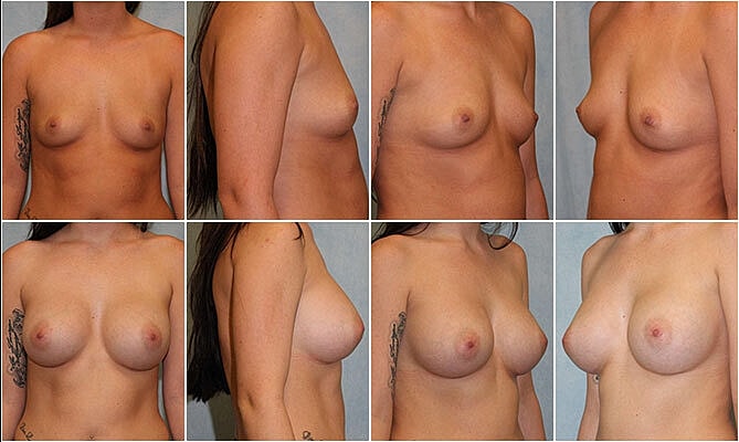 Breast Augmentation Before & After