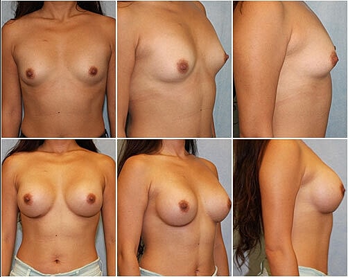 Breast Augmentation Before & After