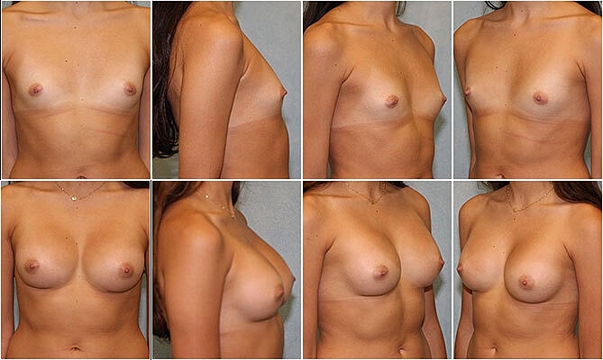 Breast Augmentation Before & After