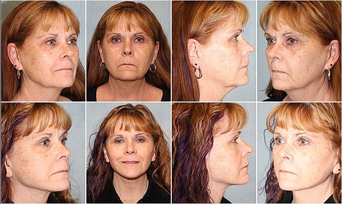 Facelift Before & After