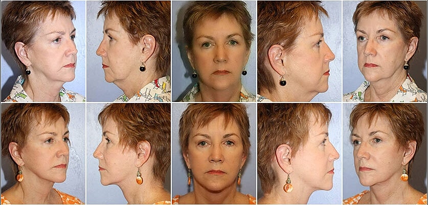 Facelift Before & After