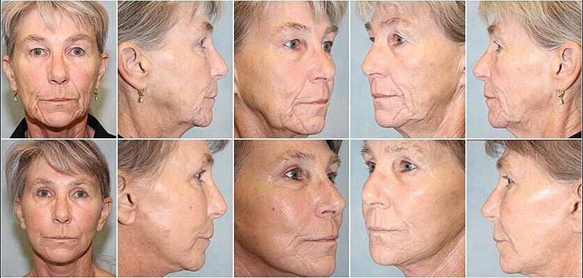 Facelift Before & After