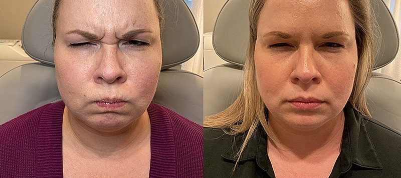Botox Before & After