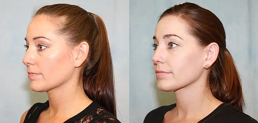 Otoplasty Before & After