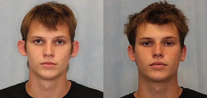 Otoplasty Before & After