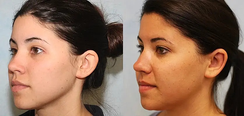Otoplasty Before & After