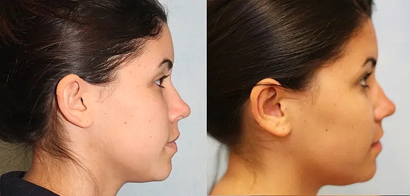 Otoplasty Before & After