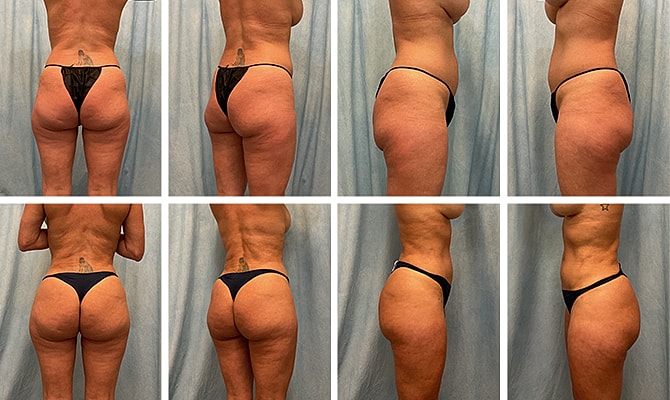Fat Transfer Before & After