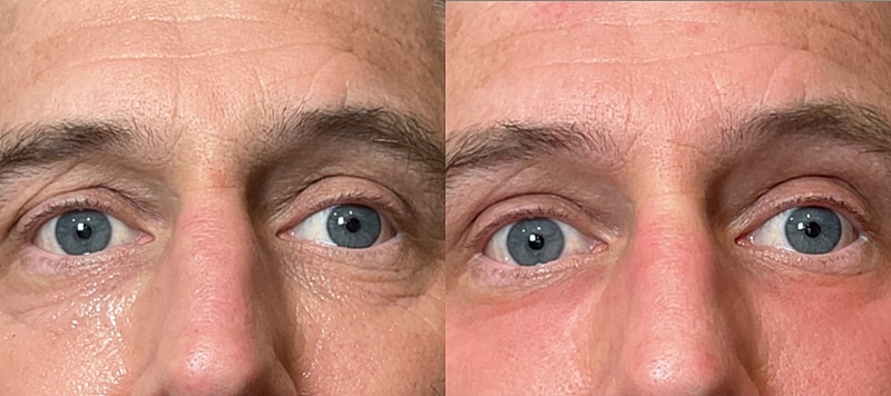 Co2 Laser Before & After