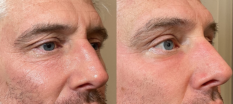 Co2 Laser Before & After