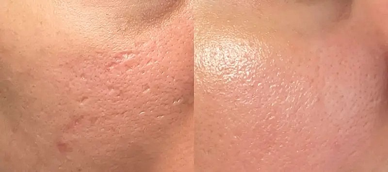 Co2 Laser Before & After